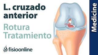 Rotura de ligamento cruzado anterior  Diagnóstico tratamiento de fisioterapia médico y quirúrgico [upl. by Felicdad]