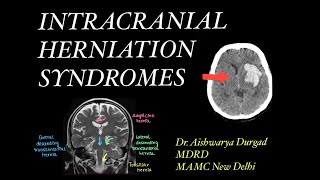 Intracranial herniation syndromes Imaging review  Relevant Anatomy [upl. by Arayc]