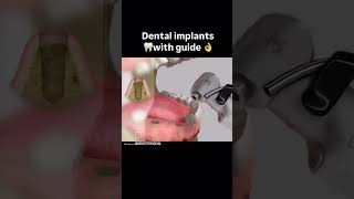 Dental Implant dental dentist dentistdoctor dentistry medicaldoctor smiledental shortvideo [upl. by Dunham224]