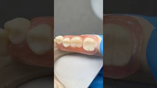 Unilateral Molar Partial ​⁠EnvisiontecMain envisiontec lsk121shorts dentist teeth [upl. by Fennell]