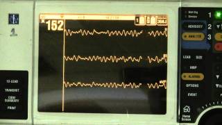 Ventricular Fibrillation [upl. by Grani]