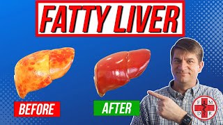 Fix Your Fatty Liver in 6 Simple Steps [upl. by Deyas]