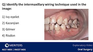 NEET MDS  INICET  Oral Surgery  Mandibular Fractures  Explanatory Video  MERITERS [upl. by Attaynek]