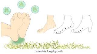 Onychomycosis  What is it and how is it treated [upl. by Winnah335]