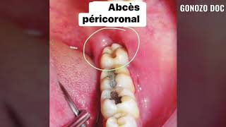 Les types dabcès dentaires ☝️ [upl. by Hinman]