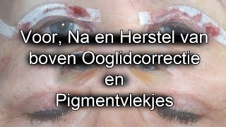 Review Boven Ooglidcorrectie en Ervaring Pigmentvlekjes verwijderen [upl. by Atiuqin991]