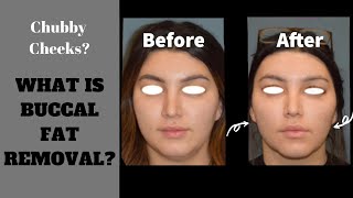 Buccal Fat Removal The Most Common Questions [upl. by Noryahs170]