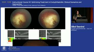 4 Fungal endophthalmitis – how is it different [upl. by Slyke]