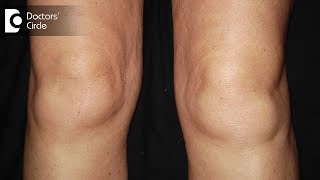 What are the causes of swelling in knees  DrNagesh HS [upl. by Ahseki757]