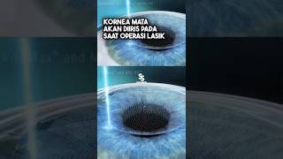 Proses saat operasi lasik mata shorts [upl. by Mcarthur199]