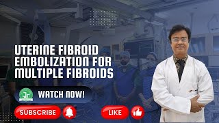 Uterine Fibroid Embolization for Multiple Fibroids  Dr Sandeep Sharma  IRFACILITIES [upl. by Acinoreb471]