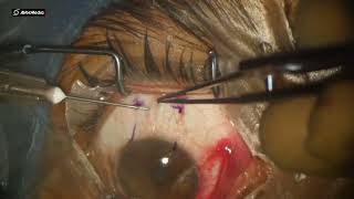 PTERYGIUM NO INJECTIONNO GLUENO STICH [upl. by Felipa570]