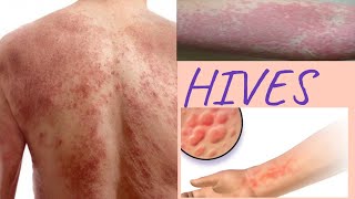 HIVES causes  Natural remedies to get rid of hive at home [upl. by Allicerp206]