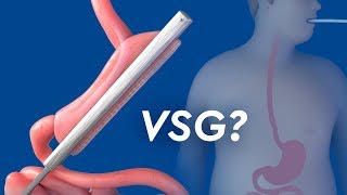 Vertical Sleeve Gastrectomy [upl. by Sitrik]