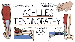 Understanding Achilles Tendinopathy Achilles Tendinitis [upl. by Eical920]