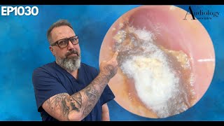 Deep Dry amp Difficult Furry Ear Wax Plug Removal  EP1030 [upl. by Gabrielle]