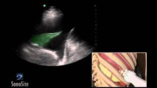 How To Ultrasound Guided Thoracentesis Exam 3D Video [upl. by Onaimad]