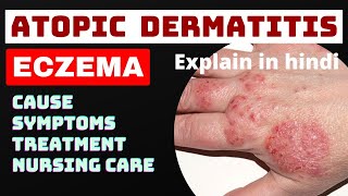 eczema  atopic dermatitis  in hindi  cause symptoms treatment nursing management skin disease [upl. by Honebein]