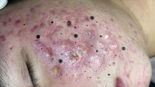 Big Cystic Acne Blackheads Extraction Blackheads amp Milia Whiteheads Removal Pimple Popping  8993 [upl. by Eugilegna]