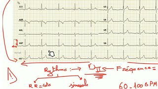 ECG  trouble du rythme et fréquence prt 1 [upl. by Ailadgim]