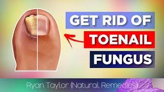 Top 3 Remedies for Toenail Fungus [upl. by Jestude]