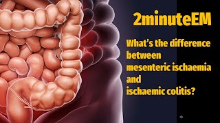 Whats the difference between mesenteric ischaemia and ischaemic colitis [upl. by Aisiat577]