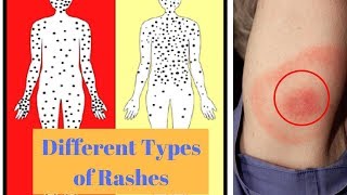 Different Types of Rashes [upl. by Namrak]