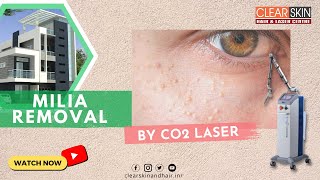 How to Remove Milia Permanently  Co2 Laser Treatment For Milia  DrNKailash Specialist Kurnool [upl. by Esiom]