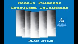 Granuloma Calcificado Nódulos pulmonares [upl. by Urquhart140]