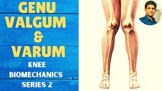 GENU VALGUM amp GENU VARUM  Knee Complex Biomechanics [upl. by Green192]