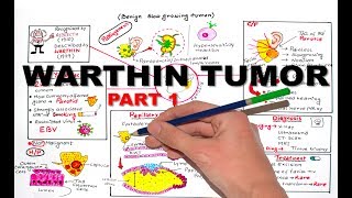 Warthin Tumor Salivay Gland Neoplasm  part 1 [upl. by Thema]