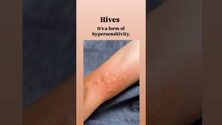 What Are Hives HivesUrticariaAllergyReliefSkinCareChronicHivesItchySkin [upl. by Elli]