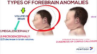 Forebrain anomalies part 1 [upl. by Yde575]