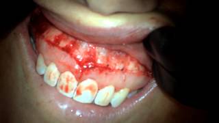 Lip Reduction Using ErCrYSGG Laser [upl. by Torrin]