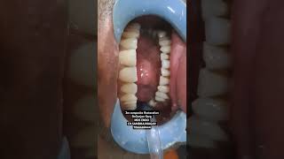 composite filling in Aurangabad fracture repair composite restoration in front teeth [upl. by Ahsieyk637]