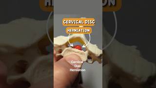 Cervical Disc Herniation Rupture of Cervical Disc Model [upl. by Anitsrihc]