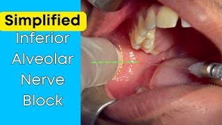 Inferior Alveolar Nerve block [upl. by Laurentium734]