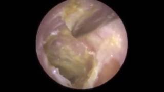 Infection of Eardrum visible after Hard Ear Wax Removal  Mr Neel Raithatha The Hear Clinic [upl. by Mariquilla]