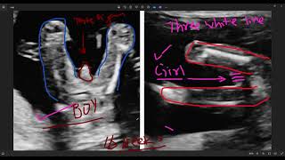 12 week ultrasound  sonography se kaise jane ladka hai ya ladki  6 week ultrasound  trimester [upl. by Plotkin541]