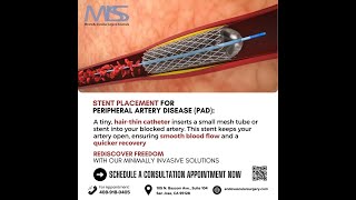 PAD Treatment Without Surgery Nonsurgical Stent Placement [upl. by Notlrac816]