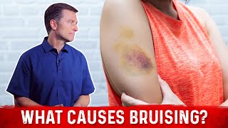 What Causes Bruising Without Trauma – Dr Berg [upl. by Nevada]