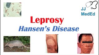 Leprosy Hansens disease  Who is at risk Signs and Symptoms Diagnosis and Treatment [upl. by Llerryt]