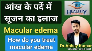 पर्दे में सूजन का इलाज  macular edema treatment  diabetic macular edema  healthyeyeofficial [upl. by Nylodnew]