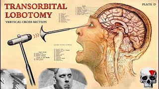 The TERRIFIC History of Lobotomy [upl. by Buerger]