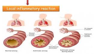 MED LEVEL2 RES LECTURE2 LOEFFLER’S SYNDROME amp VLM [upl. by Aiksa]