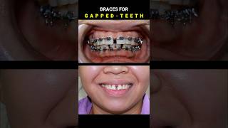 BRACES FOR GAPPED TEETH 32 MONTHS DURATION braces orthodontist dentist [upl. by Aivata834]