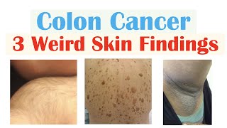 3 Weird Signs of Colon Cancer Found on the Skin [upl. by Tifanie928]