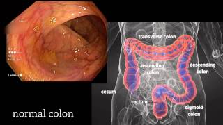 Colonoscopy A Journey Though the Colon and Removal of Polyps [upl. by Leoni]