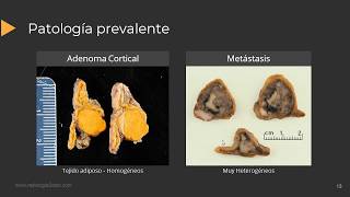 Imágenes de las Glándulas Suprarrenales [upl. by Dorella851]