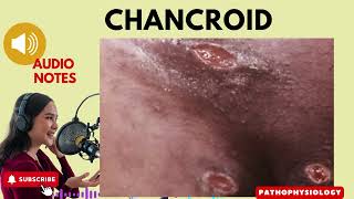 Chancroid Causes Symptoms Treatment and Prevention Audio Notes [upl. by Kcireddor]